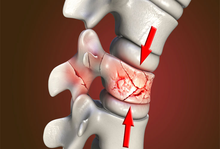 THOÁI HÓA CỘT SỐNG - CÁC PHƯƠNG PHÁP ĐIỀU TRỊ NỘI KHOA VÀ NGOẠI KHOA
