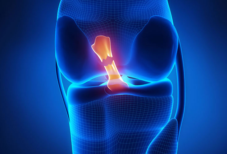 ĐỨT DÂY CHẰNG CHÉO TRƯỚC KHỚP GỐI CÓ NGUY HIỂM KHÔNG?