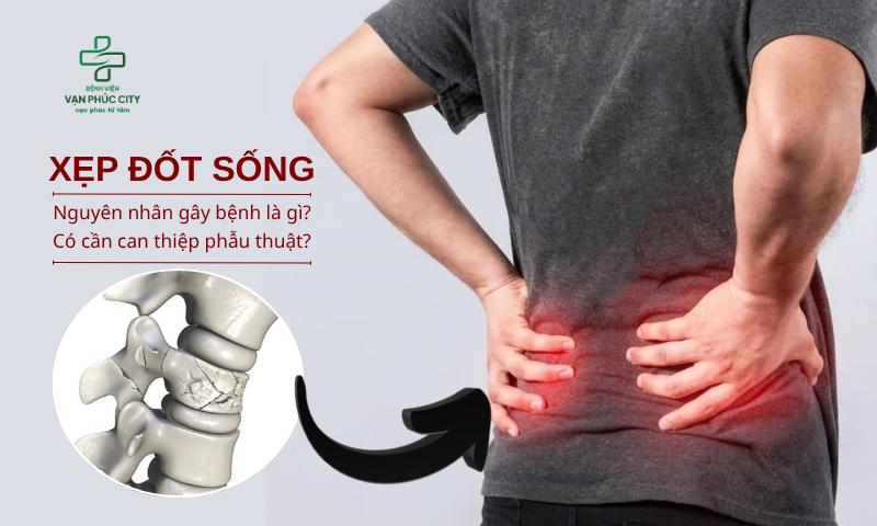 XẸP ĐỐT SỐNG - NGUYÊN NHÂN GÂY BỆNH LÀ GÌ, CÓ CẦN CAN THIỆP PHẪU THUẬT?